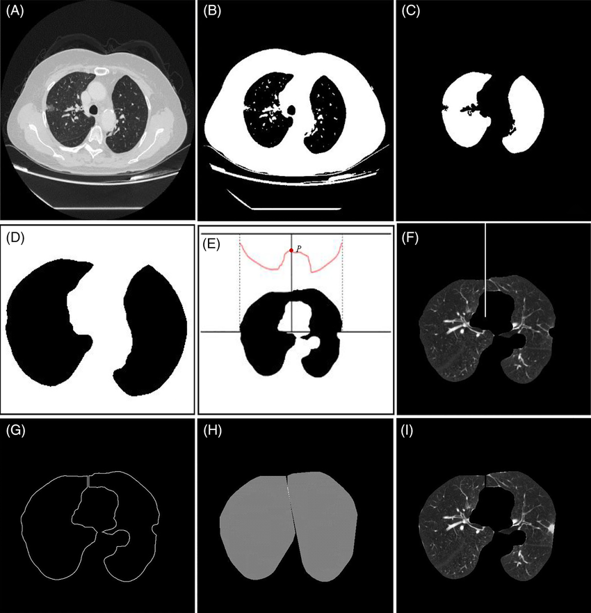 The-process-of-lung-parenchyma-segmentation-A-original-CT-image-B-threshold